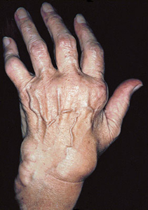 Arthritis