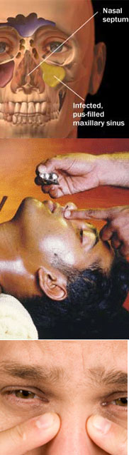 sinusitis