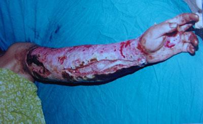snake bite result 1