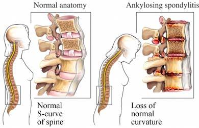 Spondylitis