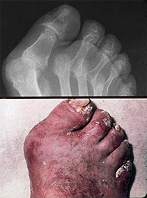 Arthritis