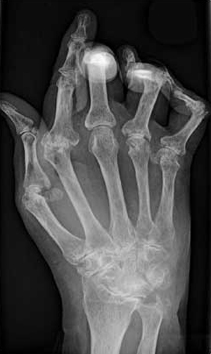 Arthritis